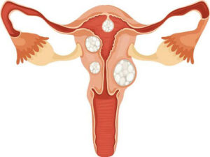 Fibroid-Symptoms-2-miami-Unique-Interventional-Radiology