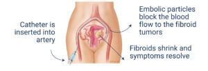 Fibroid Embolization, tumors, healthy, women, miomas, uterine fibroids, cure for fibroids, Miami, Aventura,